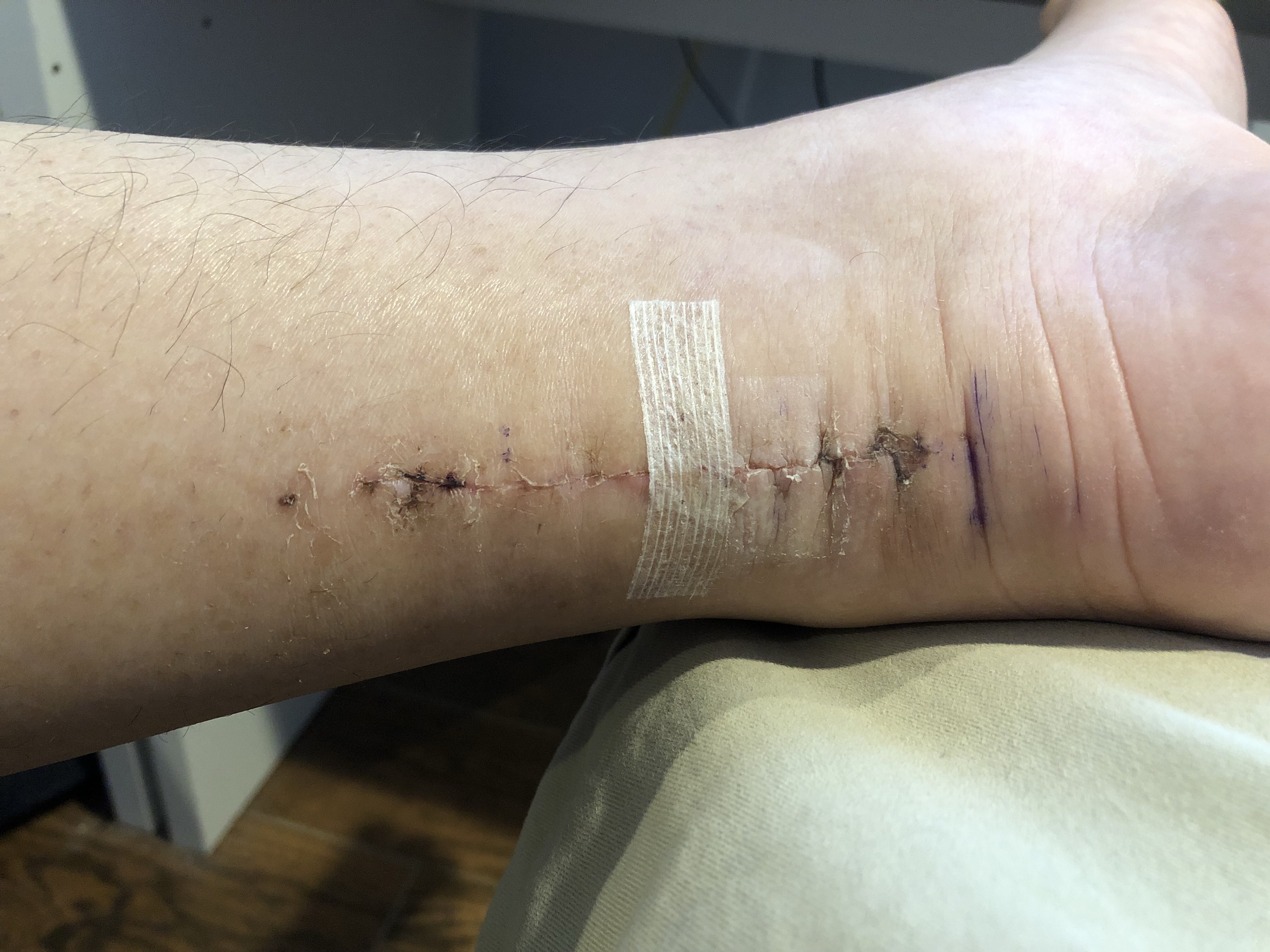 August 14th - a couple days after the tape was removed.
